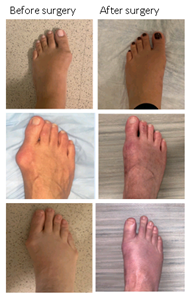 Before and After Surgery Pictures